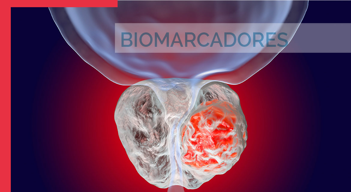 Biomarcadores en el cáncer de próstata. Visión Clínica