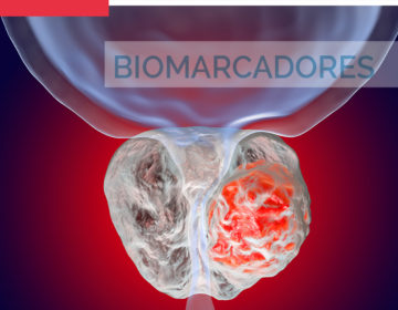 Biomarcadores en el cáncer de próstata. Visión Clínica